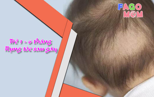 Trẻ 1-6 tháng rụng tóc sau gáy: Nguyên nhân và cách điều trị