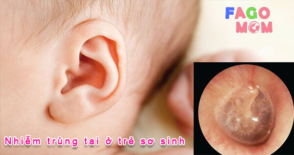 [Giải đáp từ bác sỹ] nhiễm trùng tai ở trẻ sơ sinh