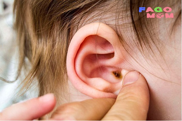 Viêm tai ngoài ở trẻ: Dấu hiệu nhận biết và cách điều trị