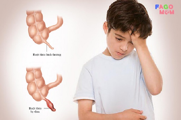 [Dấu hiệu nhận biết sớm] Viêm ruột thừa ở trẻ em