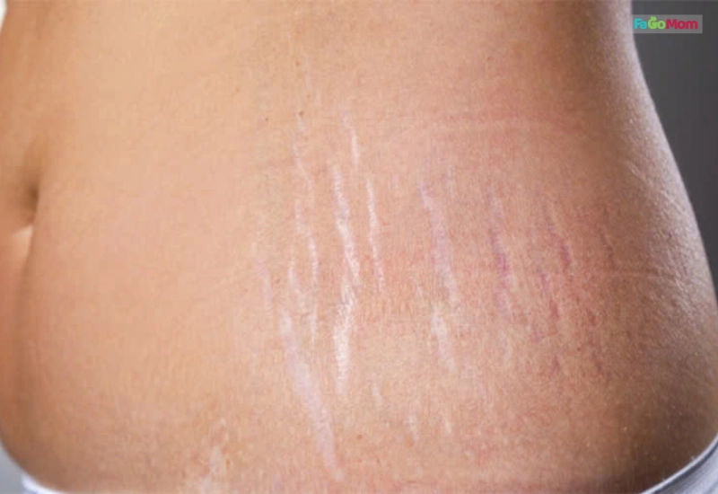 Những thay đổi của làn da sau sinh và nguyên nhân