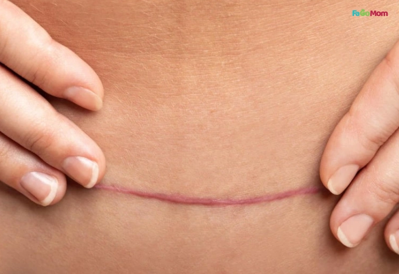 Chăm sóc vết mổ hoặc vết rạch tầng sinh môn