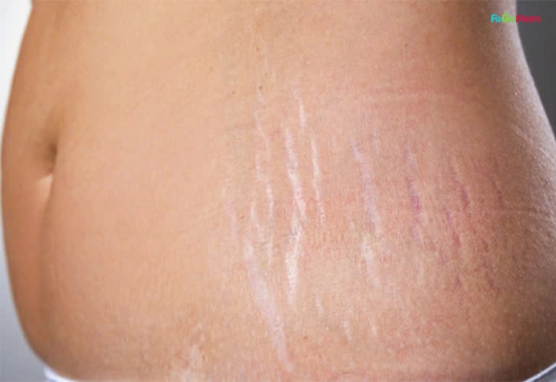 Những thay đổi của làn da sau sinh và nguyên nhân