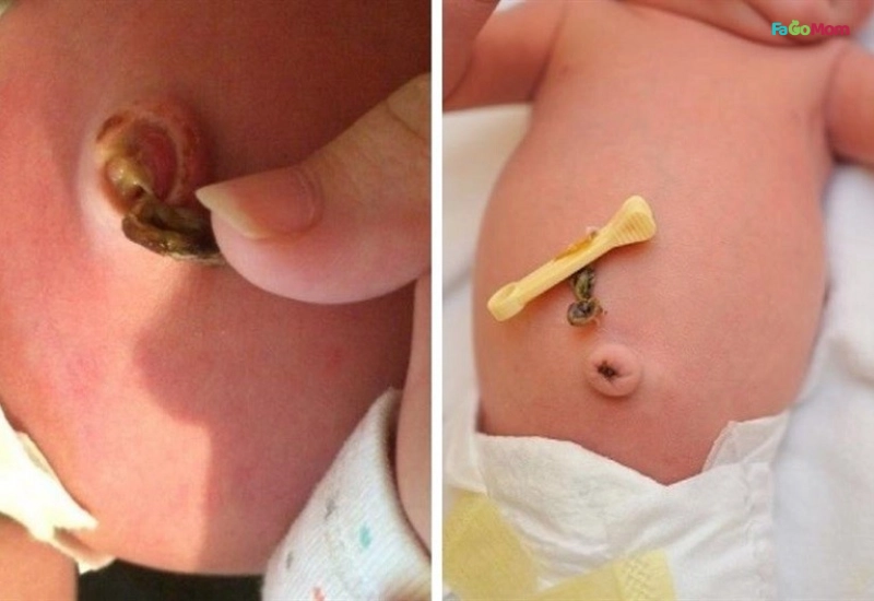 Các dấu hiệu bất thường của rốn và khi nào cần đưa bé đi khám