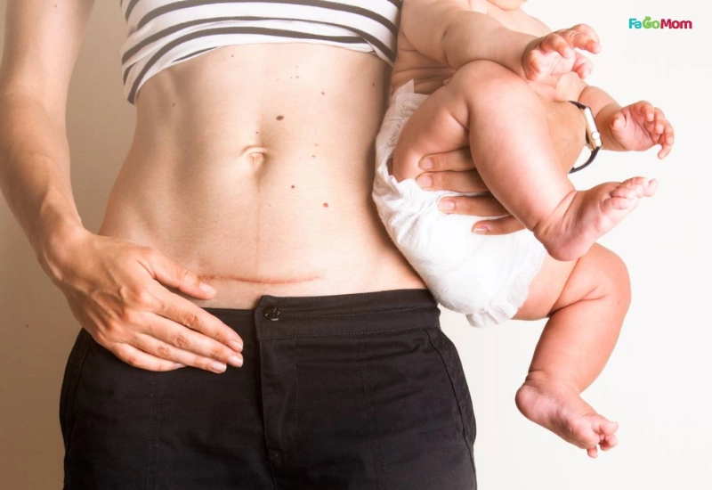 Hiểu rõ cơ thể mẹ sau sinh mổ và nguyên tắc phục hồi cơ bản