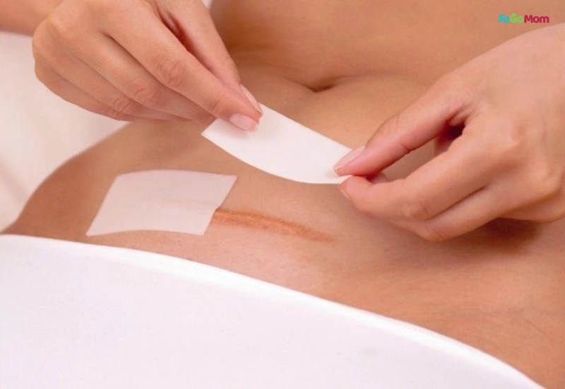 Chăm sóc vết mổ đúng cách