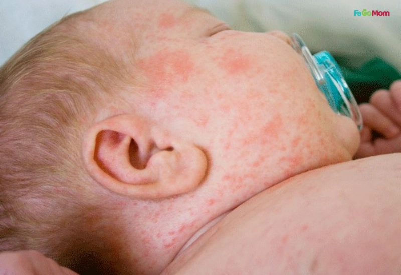 Bé đang bị viêm da cơ địa (chàm) không nên tắm cây cỏ mực