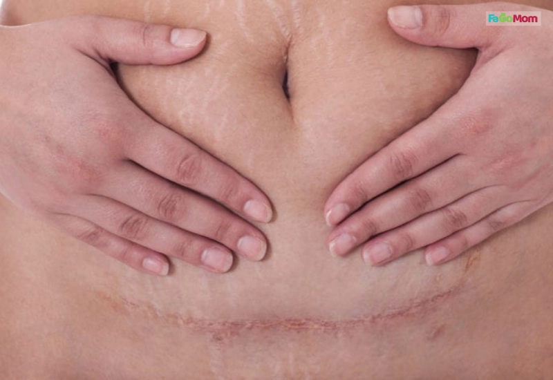 Hiểu rõ cơ thể mẹ sau sinh mổ để giảm cân an toàn