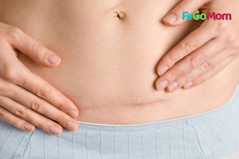 Chăm sóc vết mổ hoặc vết rạch tầng sinh môn