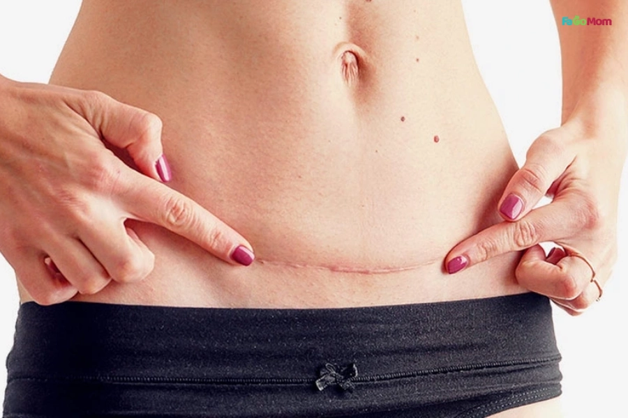 Cách Giảm Đau Vết Mổ Sau Sinh Hiệu Quả Và An Toàn Cho Mẹ Bỉm