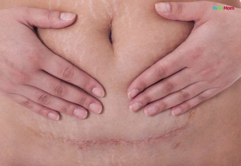 Hiểu rõ cơ thể mẹ sau sinh mổ để giảm cân an toàn