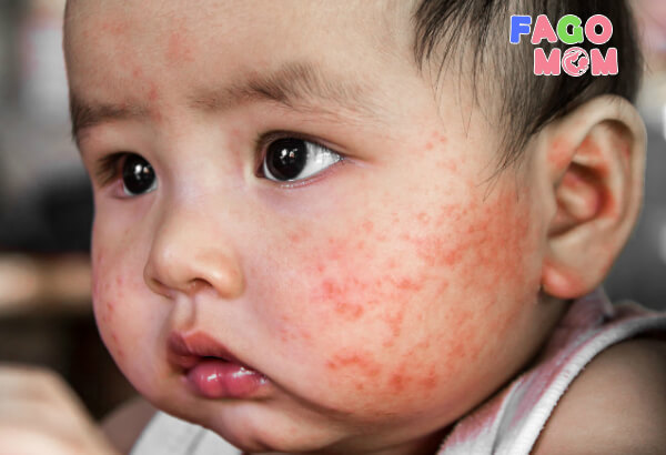 Trẻ sơ sinh bị nổi mẩn đỏ ở mặt: Nguyên nhân và cách điều trị