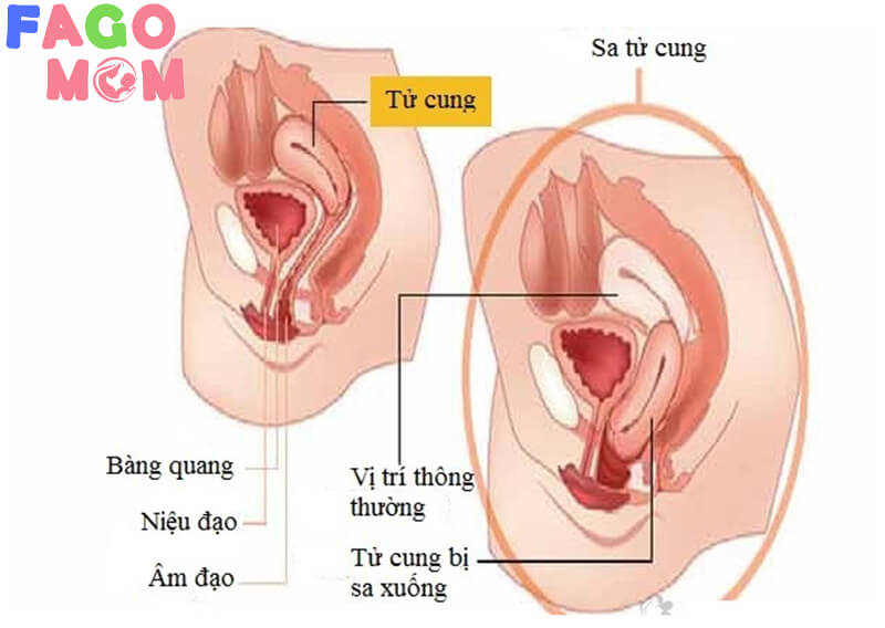 Mức độ nguy hiểm của sa tử cung ở phụ nữ sau sinh