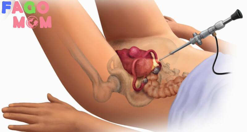 Phương pháp điều trị sa tử cung không phẫu thuật