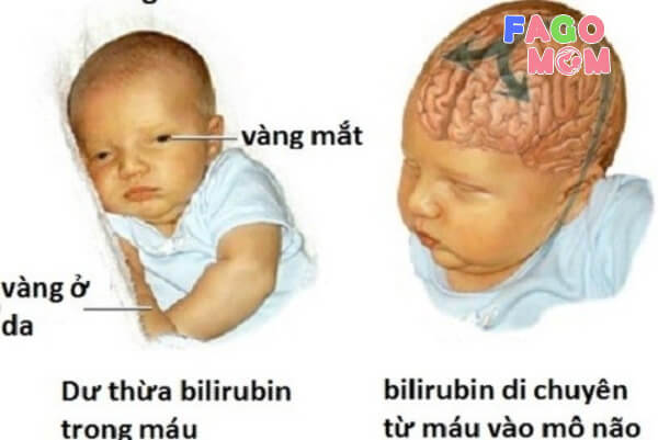 Sự nguy hiểm của trẻ sơ sinh bị vàng da vàng mắt đến não bộ