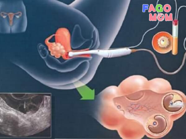 Tuổi thai nhi IVF được tính như thế nào