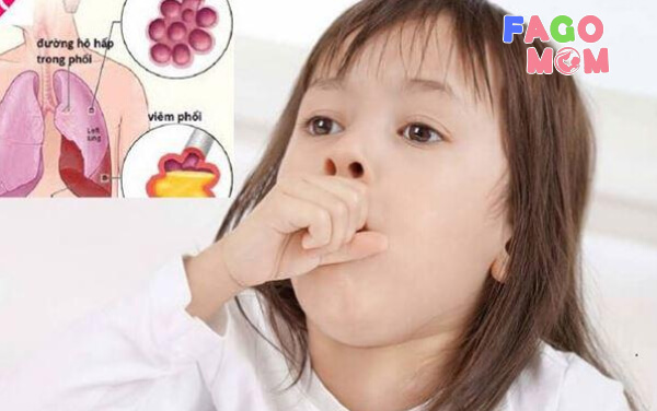 Trẻ bị viêm phổi