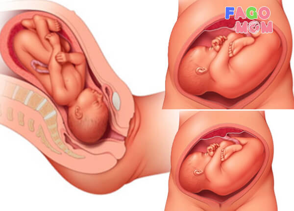 Vị trí của thai nhi dễ nhận biết nhất