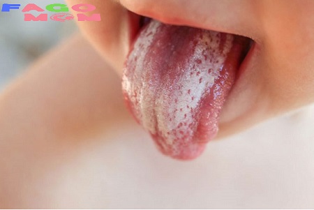 [Nấm miệng ở trẻ em] Nguyên nhân, dấu hiệu và cách điều trị