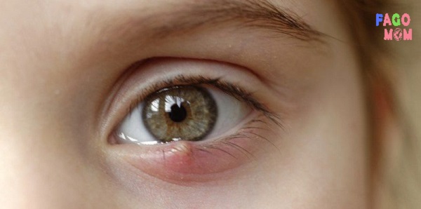 [Lẹo mắt ở trẻ em] Nguyên nhân và cách điều trị hiệu quả