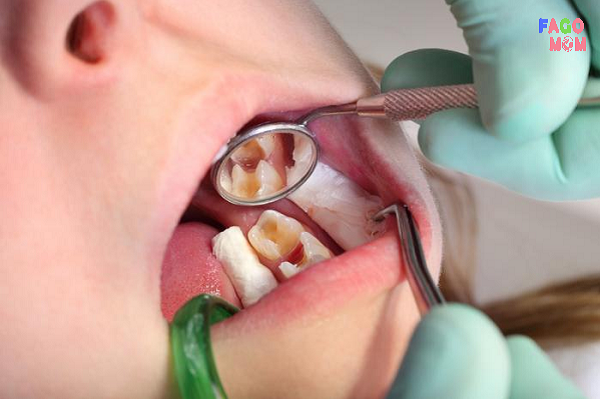 [Viêm tủy răng ở trẻ em] Dấu hiệu, chẩn đoán và điều trị