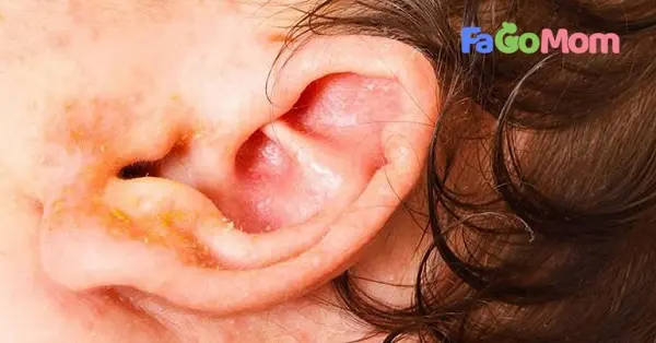 [Chàm vành tai ở trẻ sơ sinh] Những điều bố mẹ cần biết
