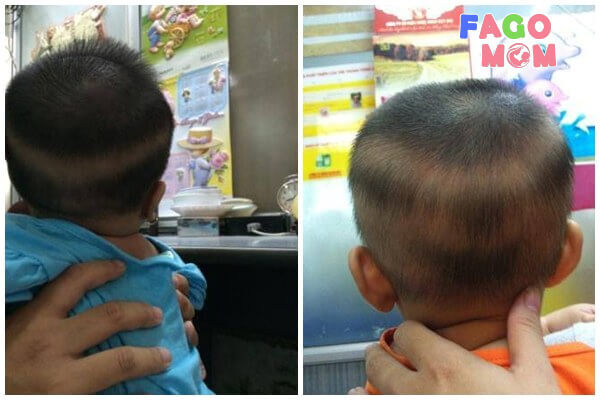 Hiện tượng rụng tóc ở trẻ em