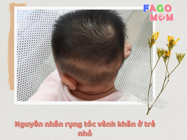 Một số nguyên nhân gây hiện tượng rụng tóc vành khăn ở trẻ