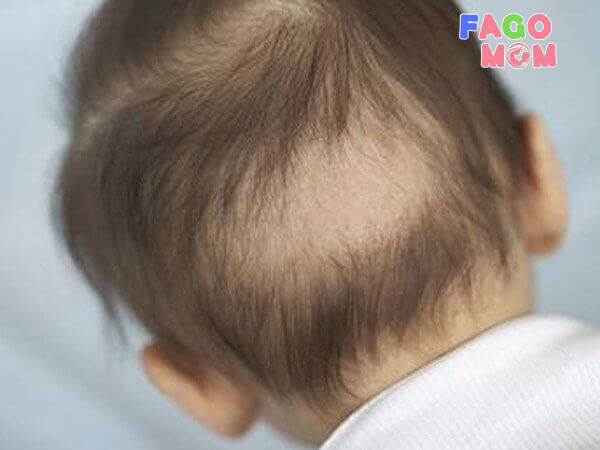 Tình trạng trẻ rụng tóc sau gáy