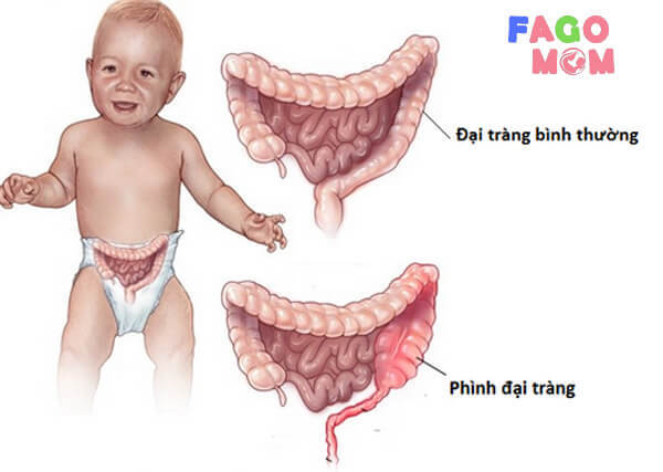 Trẻ bị táo bón do các cơ bụng và thành ruột
