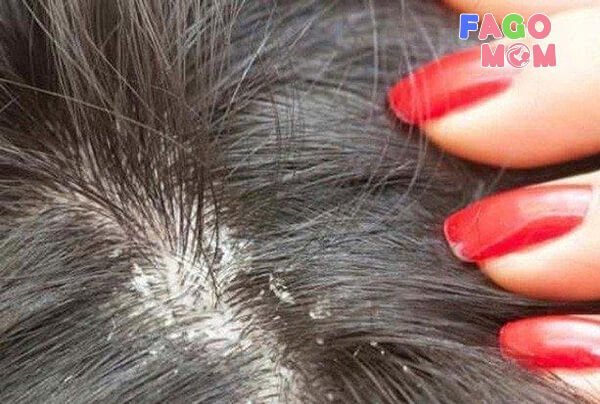 Nấm đầu là nguyên nhân dẫn đến chứng rụng tóc ở trẻ