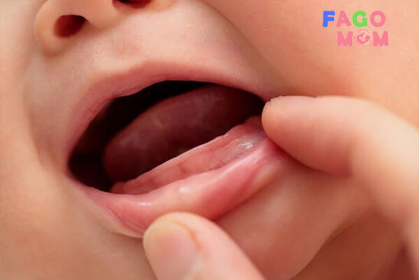  Trẻ bị nhiễm khuẩn khoang miệng cũng là nguyên nhân gây chậm mọc răng ở trẻ
