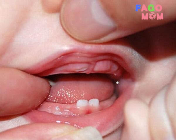 Khi bé bắt đầu mọc răng sẽ thấy sung lợi và đau, ngứa nướu