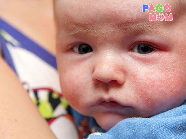 Trẻ dễ mắc các bệnh lý về da liễu như viêm da tiếp xúc,chàm hóa,…