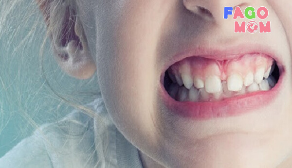 Trẻ nghiến răng do khớp cắn lệch lạc