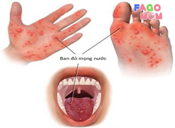Mắc bệnh tay chân miệng sau khi sốt