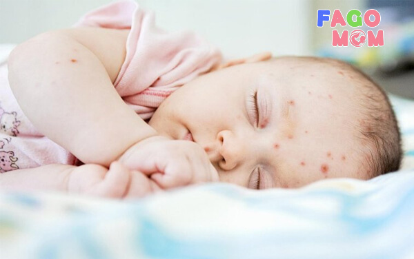Tìm hiểu về tình trạng nhiễm trung da ở trẻ sơ sinh như nào?