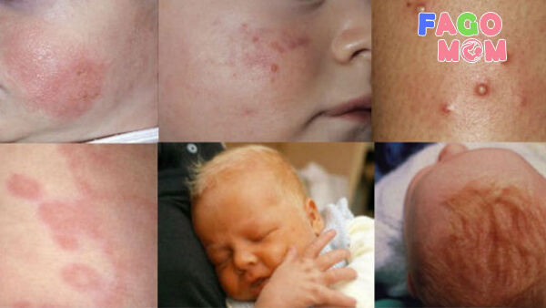 Các bệnh ngoài da ở trẻ sơ sinh