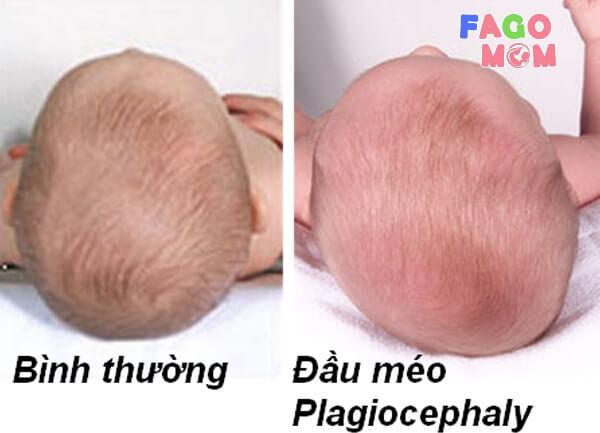 Phân biệt tình trạng đầu bị méo và đầu bình thường ở trẻ